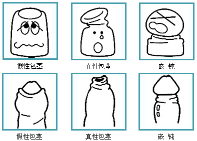 包皮包茎