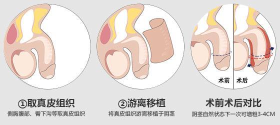 阴茎延长术是怎样一种手术