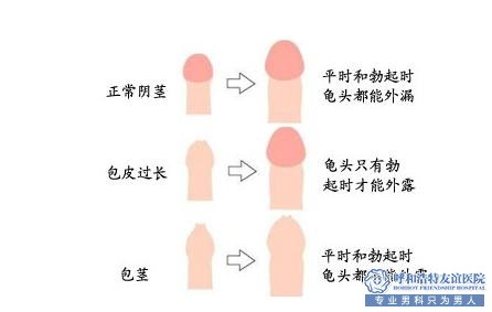 男性包皮过长的危害有哪些